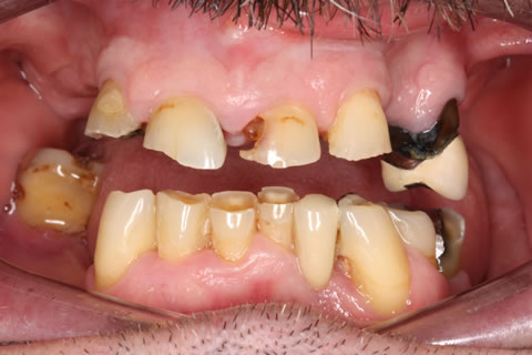 Dentures Before After  - Worn down teeth with gaps