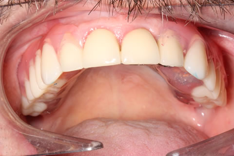 Dentures Before After  - Upper chrome-valplast with hybrid denture