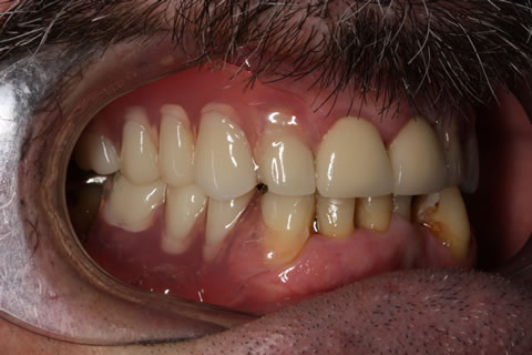 Dentures Before After  - Tooth coloured hooks for retention