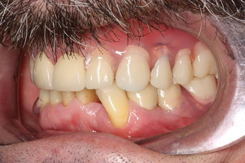 Dentures Before After  - Denture and crown treatment