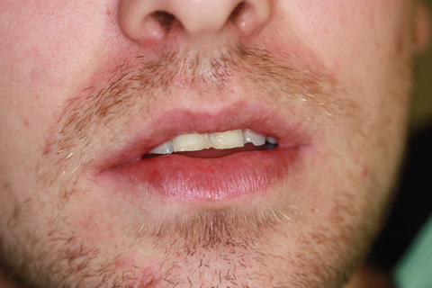 Worn/ Chipped Teeth Before After -  Front worn/ chipped teeth