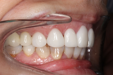 Stain Teeth Treatment Before After - Right front top/bottom arch teeth Emax veneer