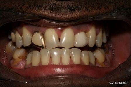 Emax Porcelain Veneers Before After - Top/Bottom teeth 