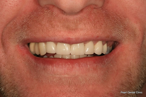 Smile Makeover Before After - Full upper teeth crown/ veneer smile makeover