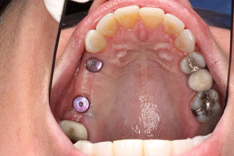 Before After Missing Molar Teeth - Upper arch missing teeth