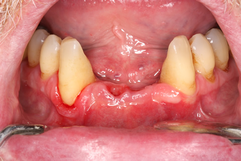 Implant Before After Missing Lower Front Teeth - Lower arch four teeth implants/bridge