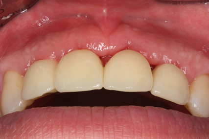 Implant Before After Bone Augmentation - Temporary cowns cemented