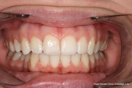 Invisalign Before After - Full upper/lower arch teeth