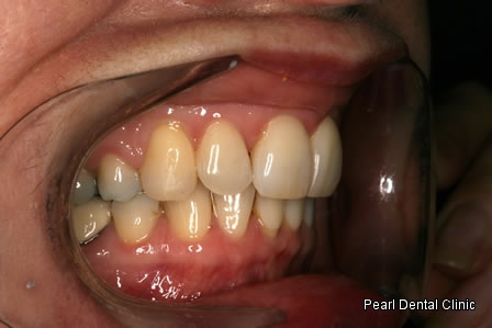 Invisalign Before After - Right full upper/lower arch teeth