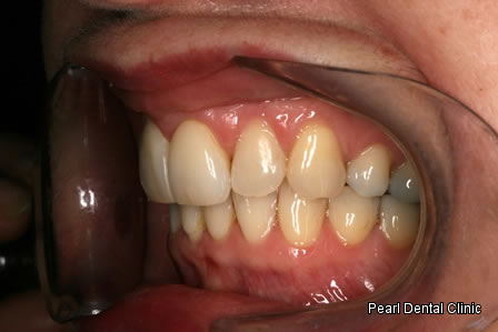 Invisalign Before After - Left full upper/lower arch teeth