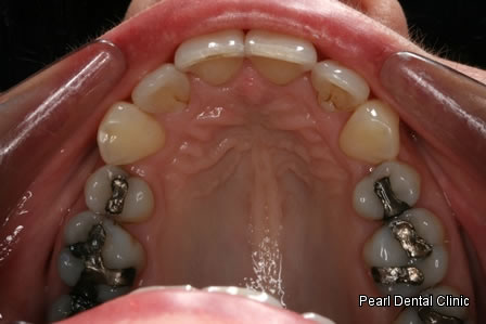 Invisalign Before After - Upper arch teeth