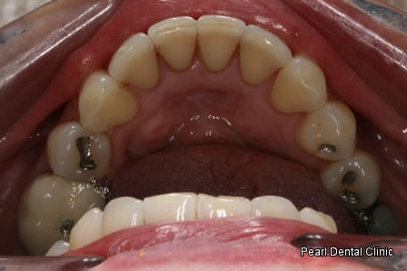 Invisalign Before After - Bottom arch teeth