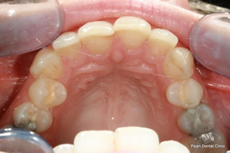 Invisalign Before After - Upper arch teeth