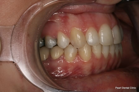 Invisalign Before After - Right full upper/lower arch teeth