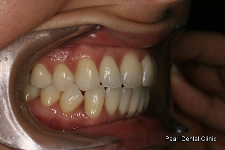 Invisalign Before After - Right full upper/lower arch teeth