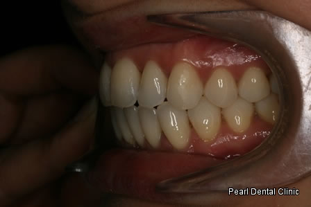 Invisalign Before After - Left full upper/lower arch teeth