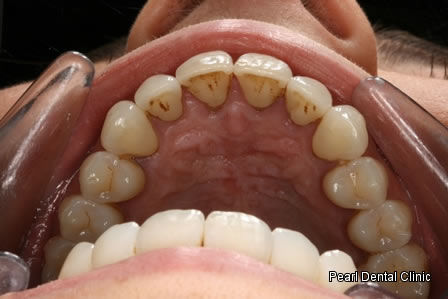 Invisalign Before After - Upper arch teeth