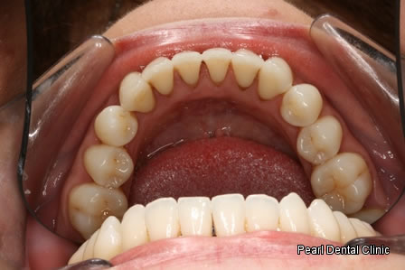 Invisalign Before After - Bottom arch teeth