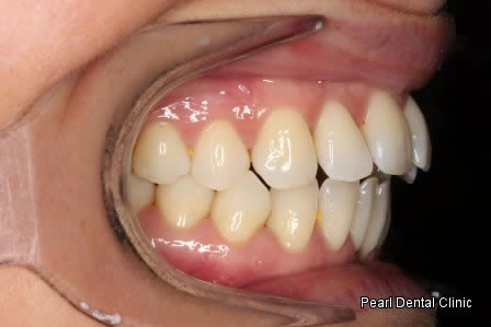 Invisalign Before After - Right full upper/lower arch teeth