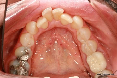 Invisalign Before After - Bottom arch teeth