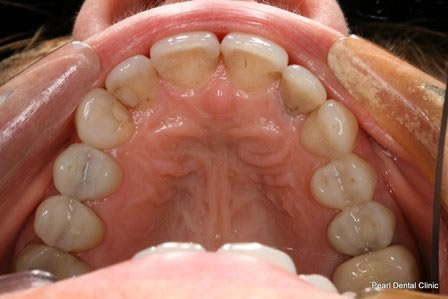 Invisalign Before After - Upper arch teeth