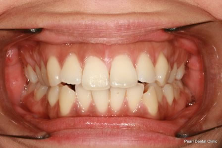 Invisalign Before After - Full upper/lower arch teeth