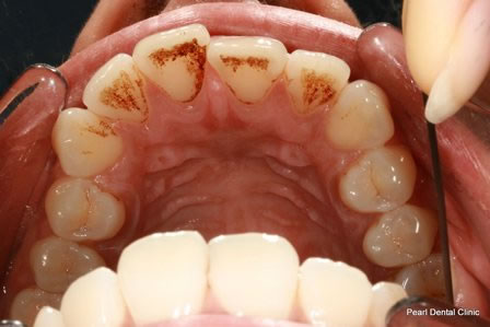 Invisalign Before After - Upper arch teeth