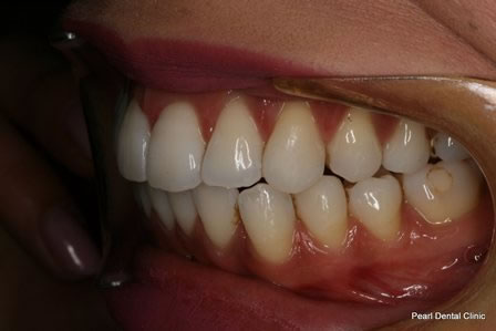 Invisalign Before After - Left full upper/lower arch teeth