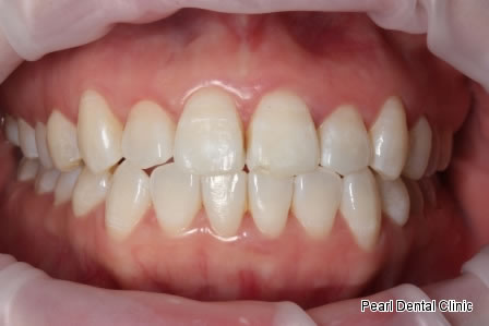 Invisalign Before After- Upper/Bottom full arch teeth  