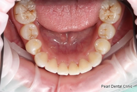Invisalign Before After- Lower full arch teeth  
