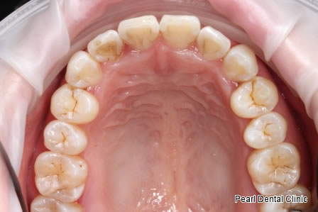 Invisalign Before After- Upper full arch teeth  