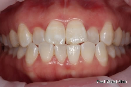 Invisalign Before After - Upper/Bottom full arch teeth  
