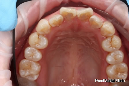 Invisalign Before After - Upper full arch teeth  