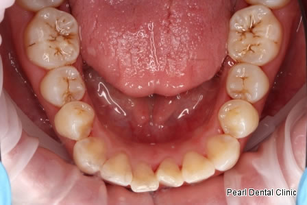 Invisalign Before After - Lower full arch teeth  
