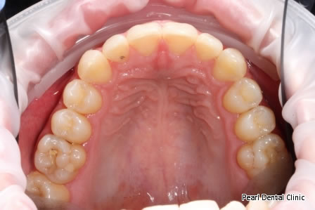 Invisalign Before After- Upper full arch teeth  