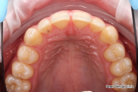 Invisalign Before After/ Frenectomy - Upper full arch teeth  