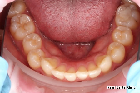 Invisalign Before After/ Frenectomy - Lower full arch teeth  