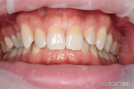 Invisalign Before After/ Cosmetic/ Bleaching - Full upper/lower arch teeth 