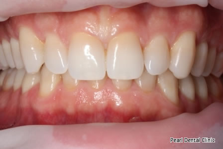 Invisalign Before After/ Cosmetic/ Bleaching - Full upper/lower arch teeth 