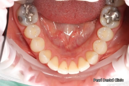 Invisalign Before AfterAnterior - Lower arch teeth 