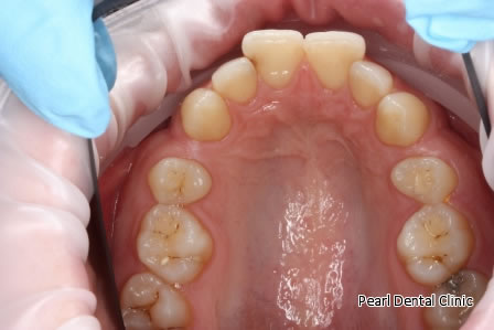 Invisalign Before After/ Bleaching - Upper arch teeth 