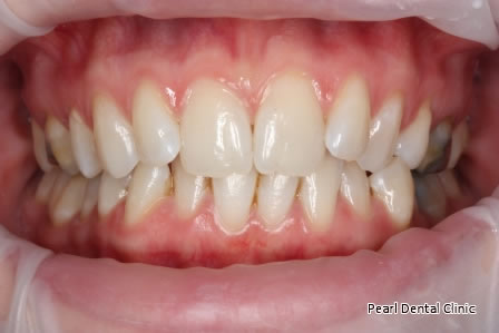 Invisalign Before After - Upper/lower arch teeth 