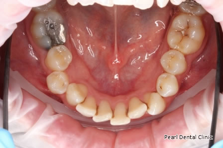 Invisalign Before After - Lower arch teeth 