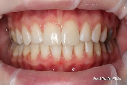 Invisalign Before After- Upper/lower arch teeth 