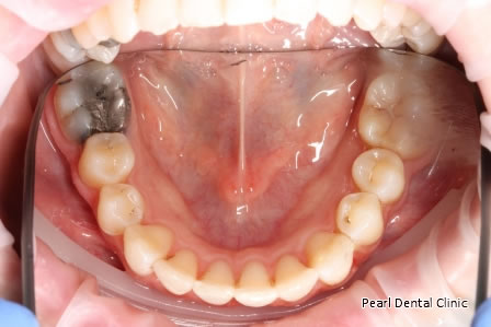 Invisalign Before After- Lower arch teeth 