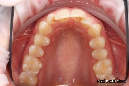 Invisalign Before After - Upper arch teeth 