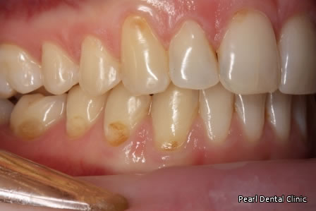Invisalign Before After- Right upper/lower arch teeth 