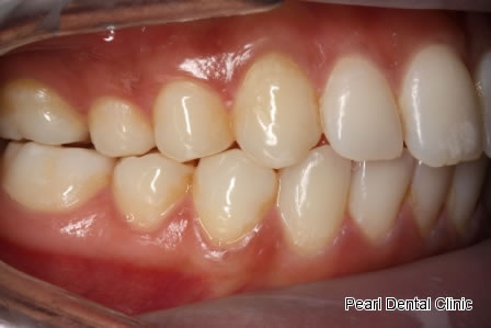 Invisalign Before After- Right full top/bottom arch teeth 