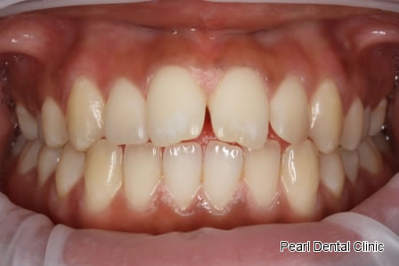 Invisalign Before After - Full top/bottom arch teeth 