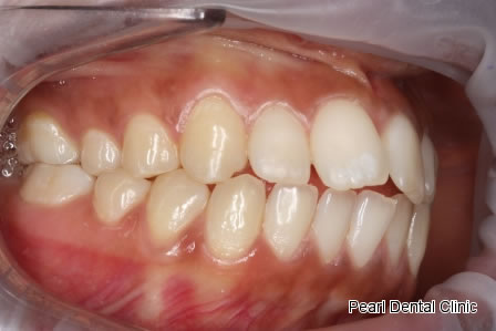 Invisalign Before After - Right full top/bottom arch teeth 